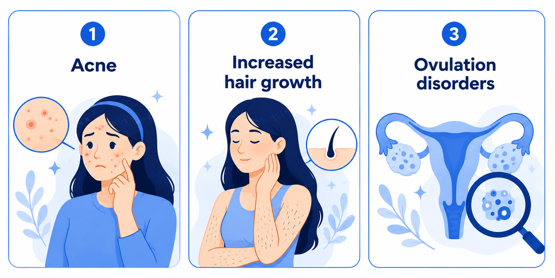 A clean blue-and-white medical infographic with three numbered vertical cards. The first card shows a woman with facial breakouts and the label “Acne.” The second shows a woman with visible body hair and the label “Increased hair growth.” The third shows a uterus and ovaries illustration with a magnifying glass and the label “Ovulation disorders.”