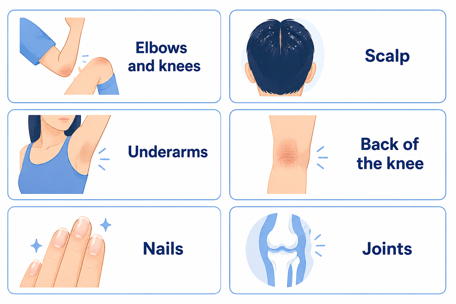 English medical infographic on a white background with six rounded rectangular cards outlined in light blue. Each card shows a simple 2D illustration of a body area with bold navy text labels: “Elbows and knees,” “Scalp,” “Underarms,” “Back of the knee,” “Nails,” and “Joints.” The design uses soft blue accents and clean medical-style illustrations.